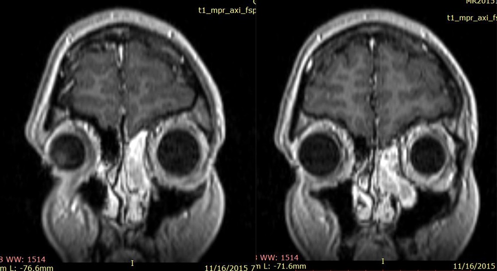 Figura 1. Examen RMN craniocerebral cu substanță de contrast efectuat în 2015