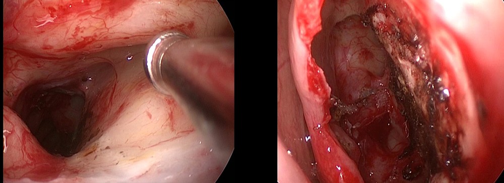 Figura 4. A – control endoscopic transnazal la finalul intervenției; B – control endoscopic extern – canal nazofrontal