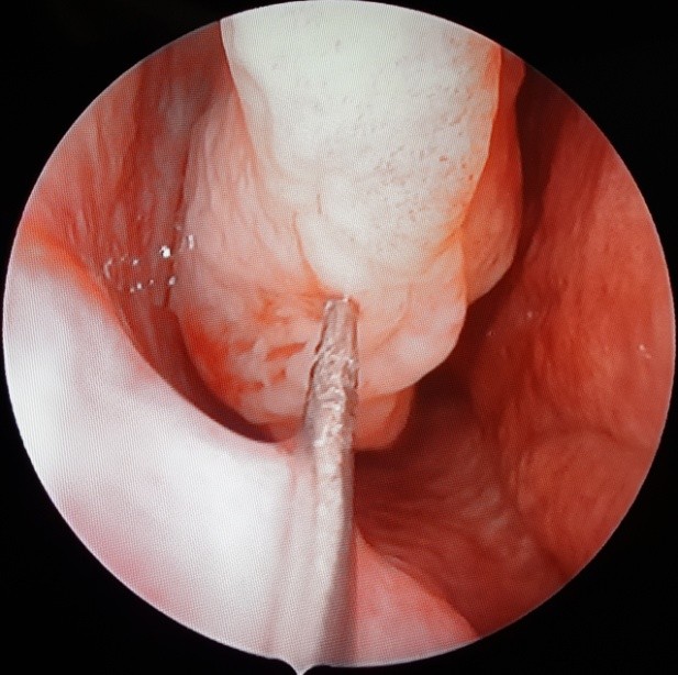 Figura 1. Infiltrație anestezică în cornetul inferior