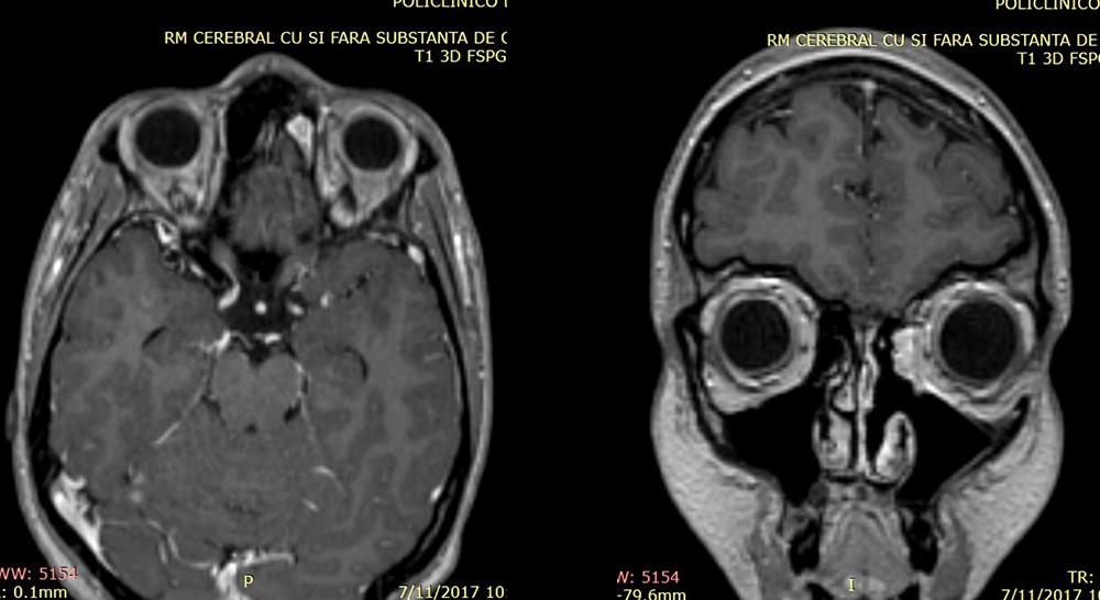 Figura 3. RMN postoperatoriu restanță tumorală localizată în canalul nazofrontal stâng