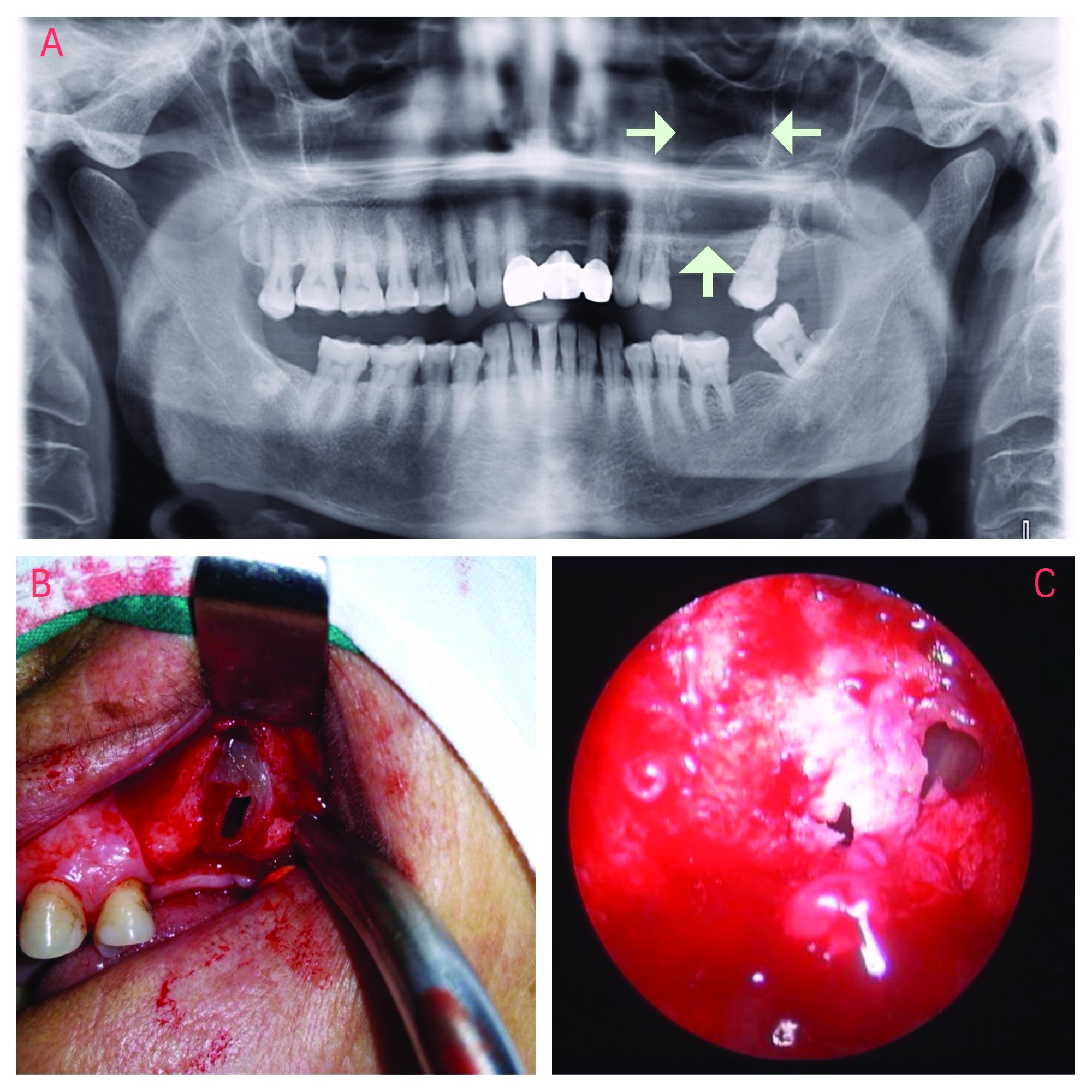 Figura 1‑1. A. Chist maxilar stâng cu extensie in sinusul maxilar – RX panoramic; B. Imagine intraoperatorie;  C. Fotografie endoscopie sinuzală