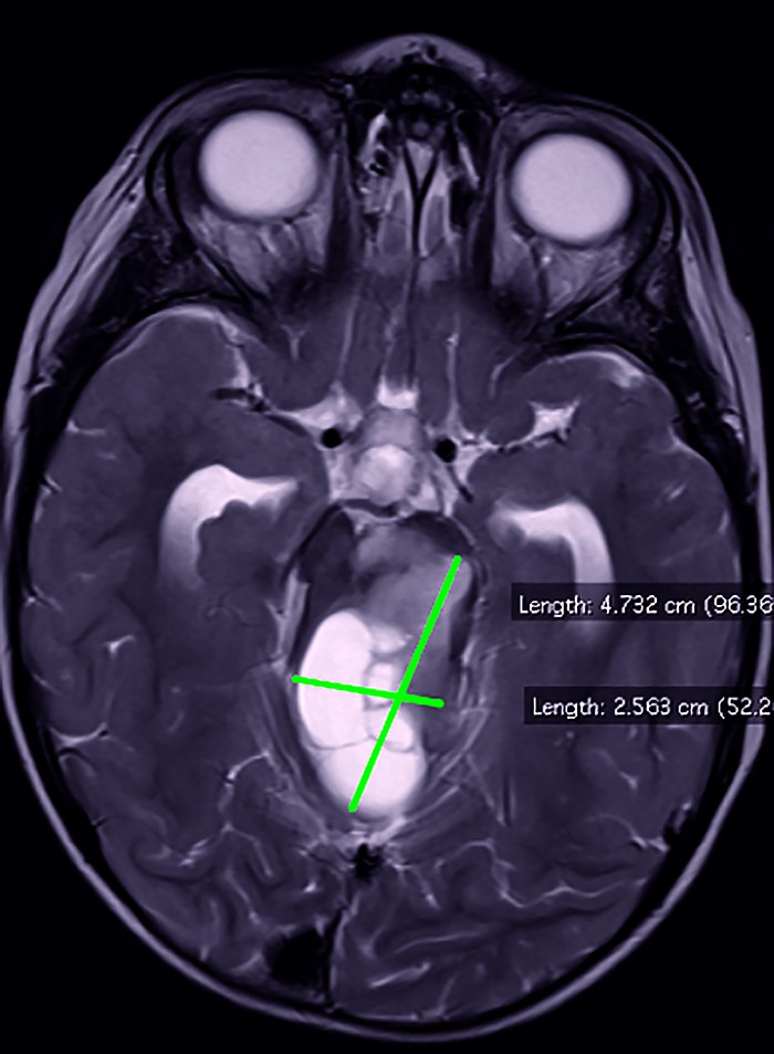 Figura 1. IRM cerebral secvență T2 ponderată, secțiune transversală, formațiune tumorală la nivelul trunchiului cerebral (imagine din arhiva secției de Neurologie Pediatrică a Spitalului de Copii „Dr. Victor Gomoiu” București)