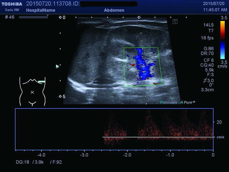 Figurile 3. Examinare Doppler - prezenţa trombului la nivelul venei renale stângi