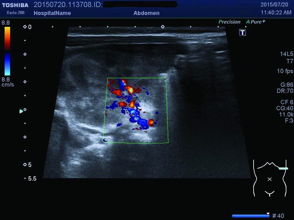 Figurile 4. Examinare Doppler - prezenţa trombului la nivelul venei renale stângi