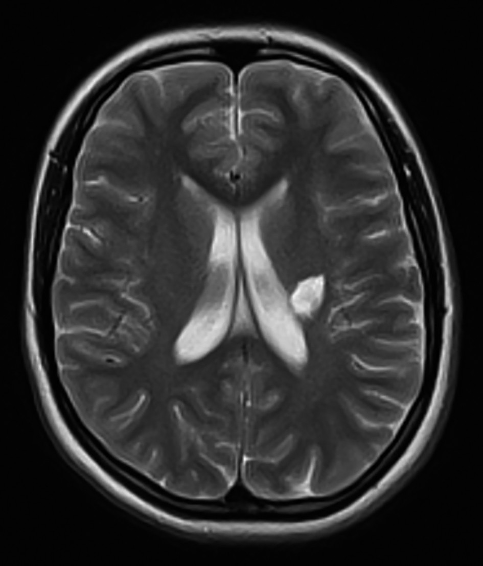 Figura 5. M.N. - IRM cerebral secvența T2