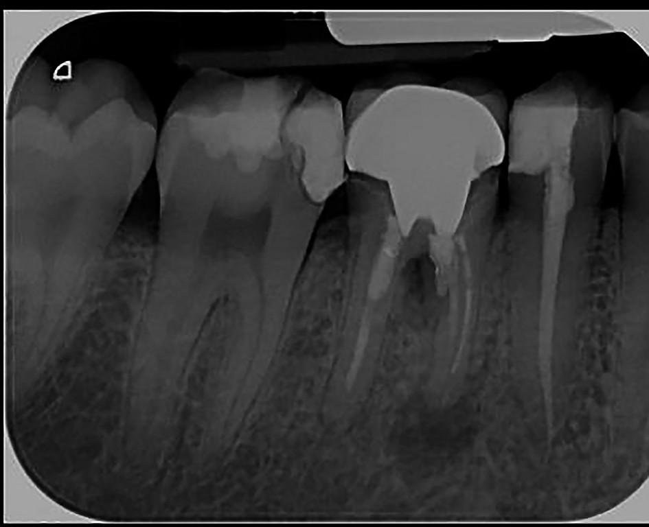 Figure 5. Large chronic apical periodontitis 46 which cannot be endodontically treated - the tooth has to be extracted