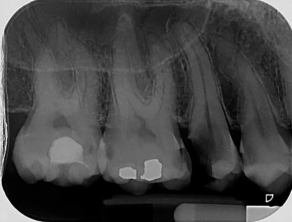 Figure 1. Chronic apical periodontitis 15 which can be endodontically treated