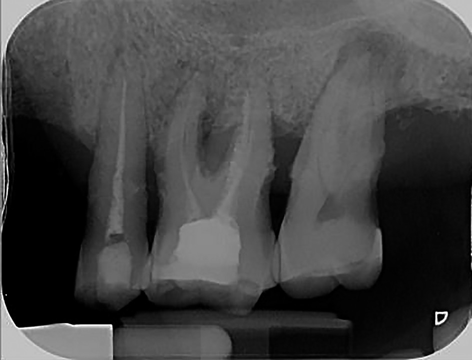 Figure 2. Large chronic apical periodontitis 17 which cannot be endodontically treated; the tooth has to be extracted