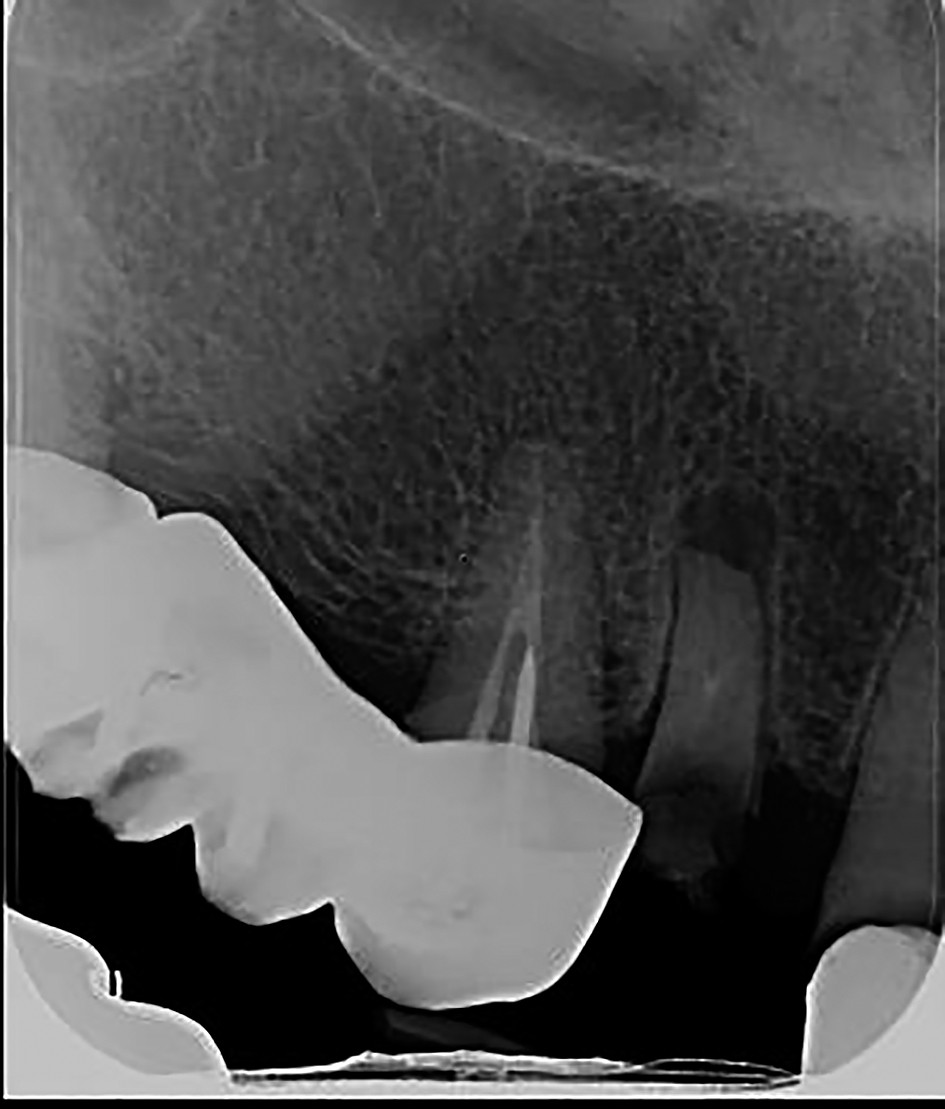 Figure 4. Apical granuloma 13 - endodontic treatment cannot be done, the tooth has to be extracted