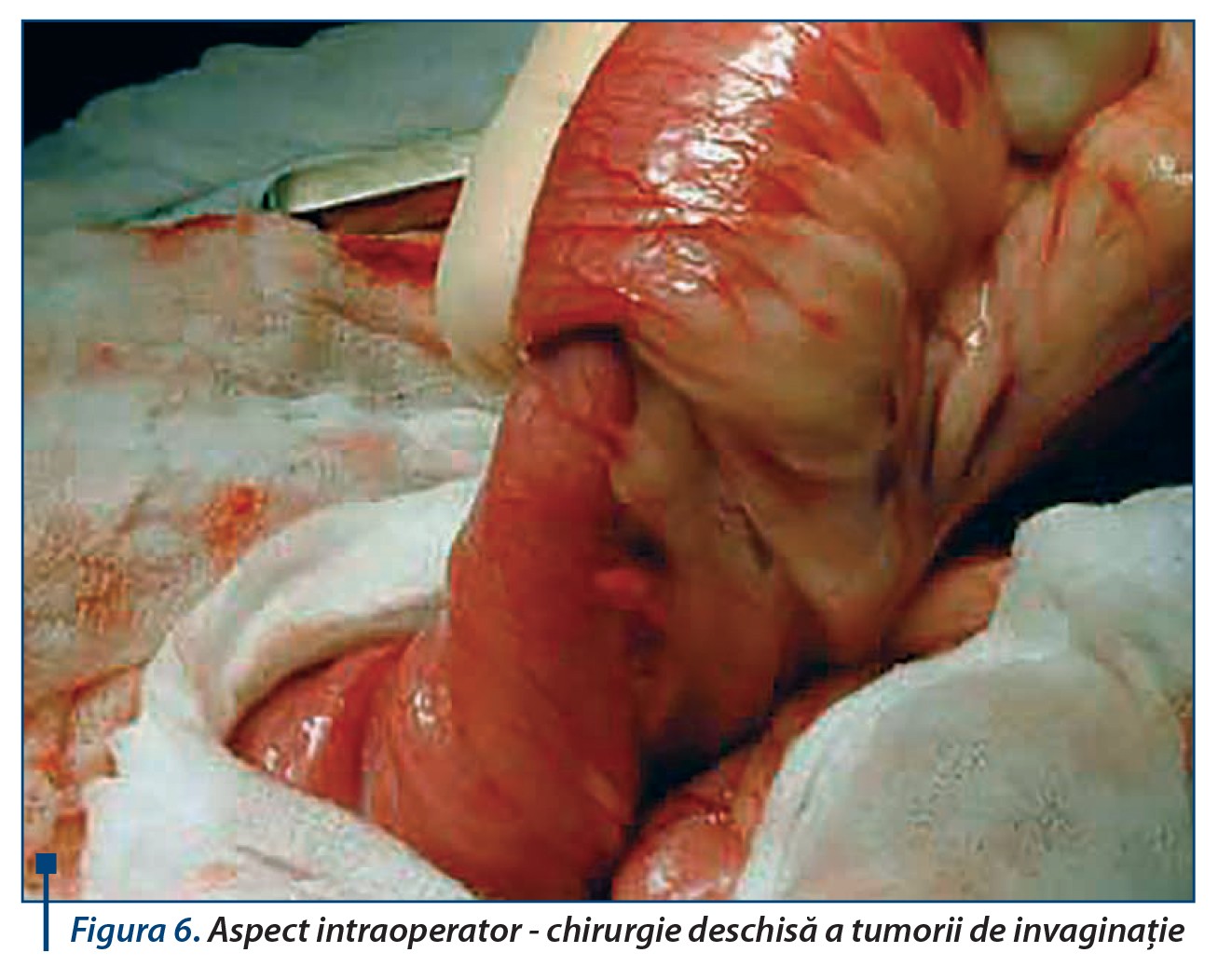 Figura 6. Aspect intraoperator - chirurgie deschisă a tumorii de invaginație
