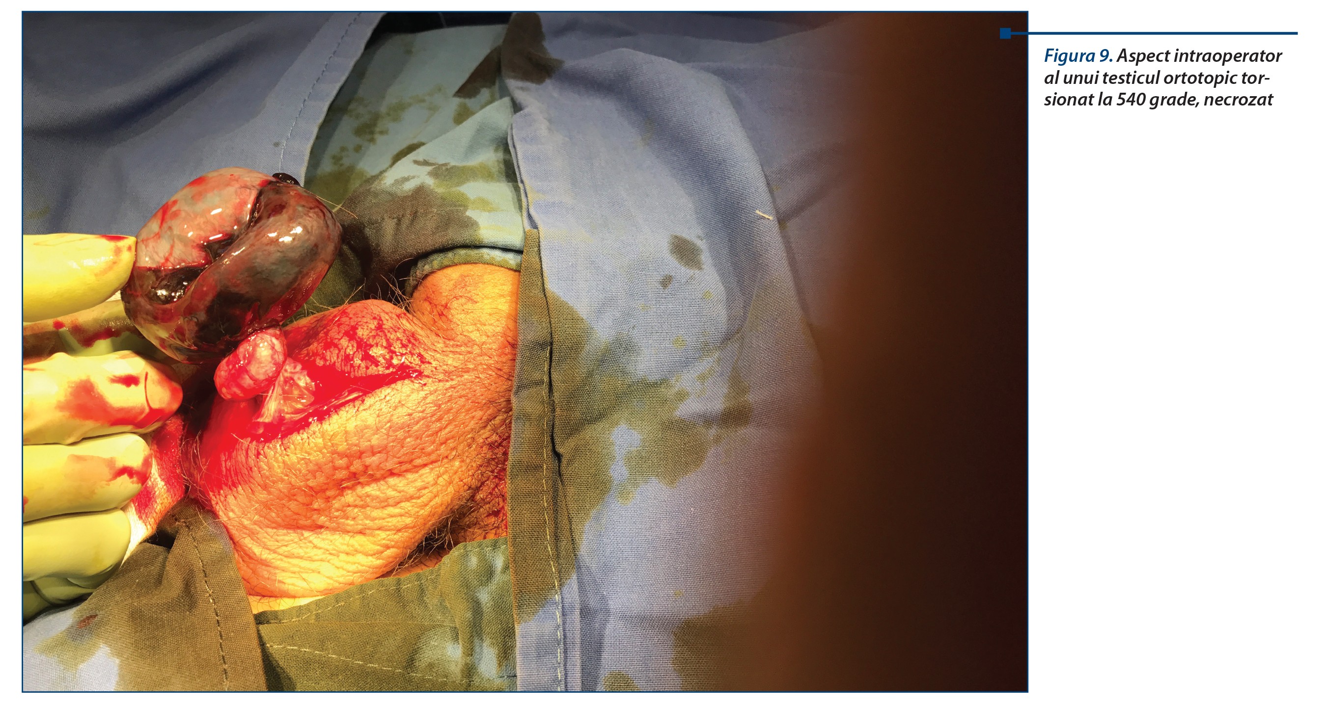 Figura 9. Aspect intraoperator al unui testicul ortotopic torsionat la 540 grade, necrozat