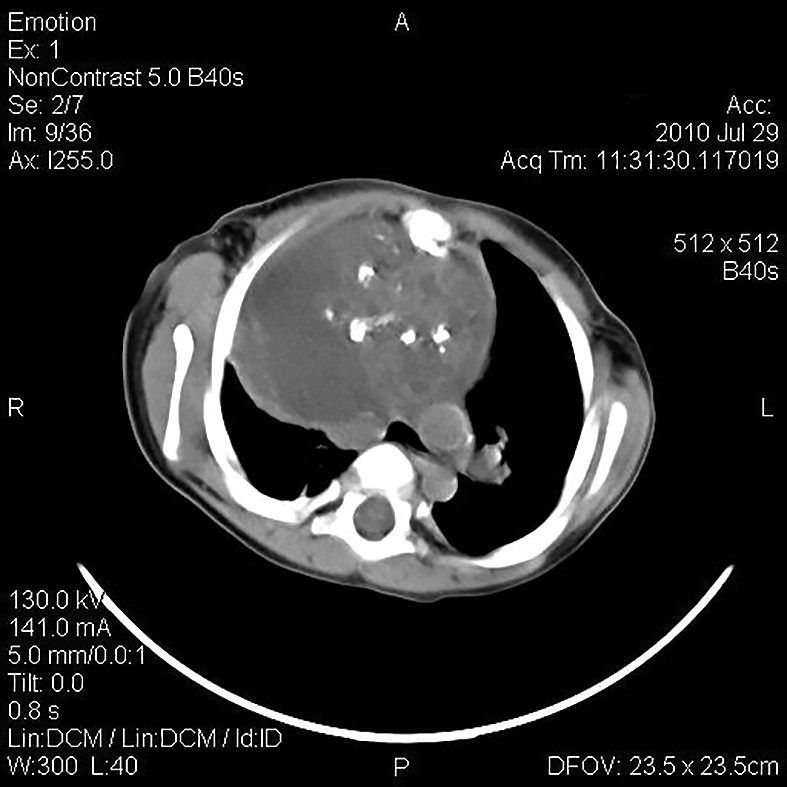 Figura 2. Examinarea CT - formațiune aparent chistică situată lateromedia­stinal drept