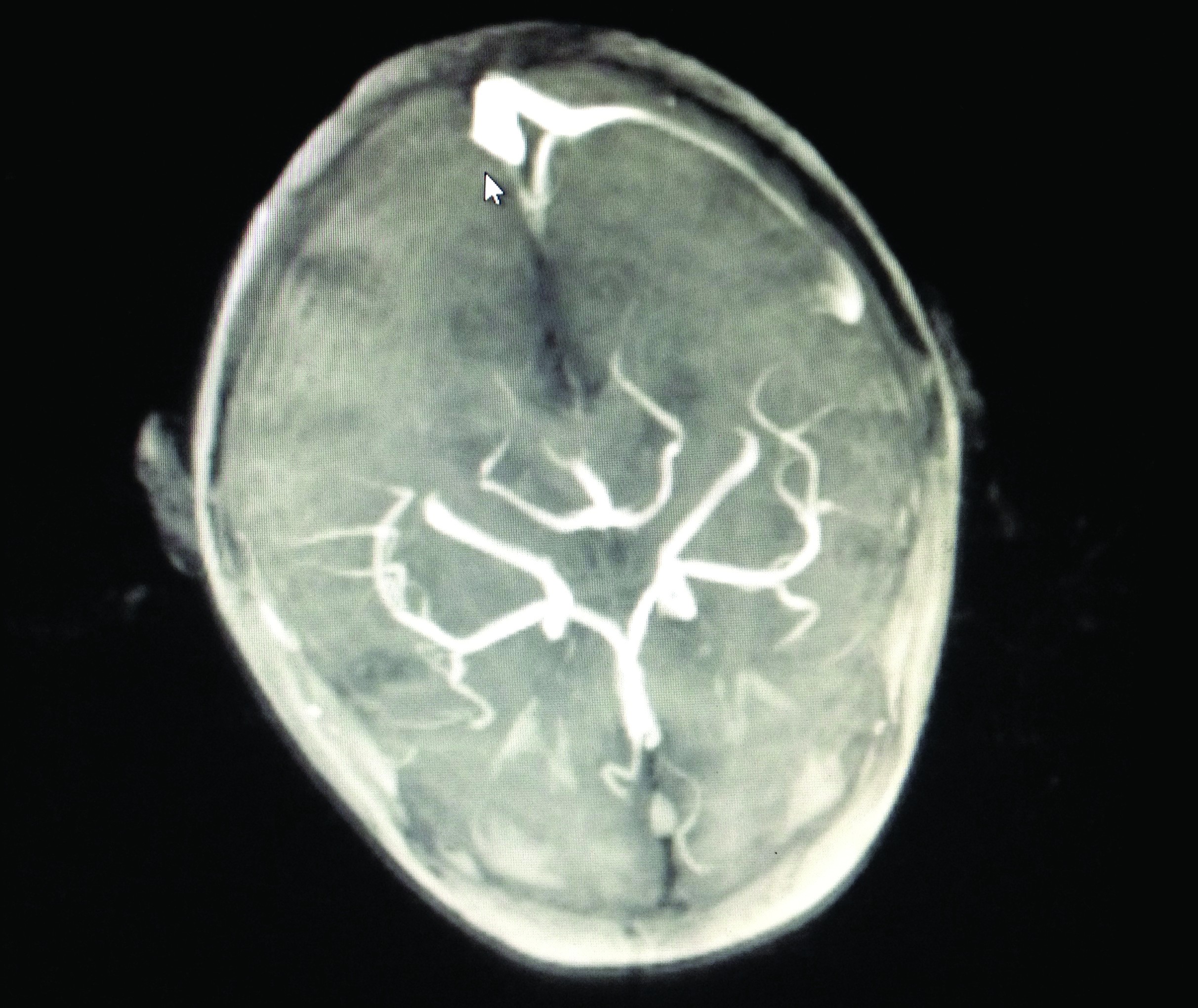 Figura 2. Tromboză de sinus venos sigmoid și transvers pe partea dreaptă. IRM cerebral