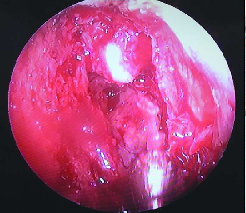 Figura 2. Imagine endoscopică a osteomului fronto-etmoidal cu tija de 70º
