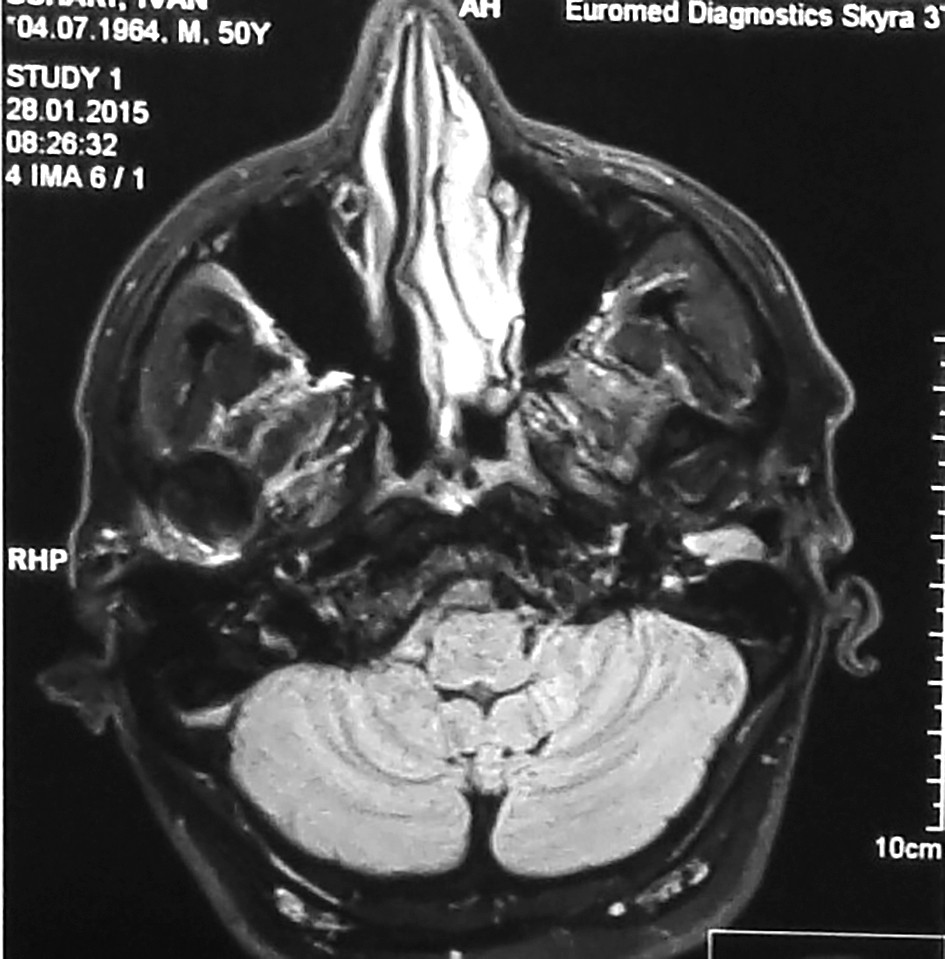 Figura 2. Examen CT - formațiune voluminoasă la nivelul conductului auditiv extern al urechii stângi, de origine vasculară (conform valorilor densimetrice)