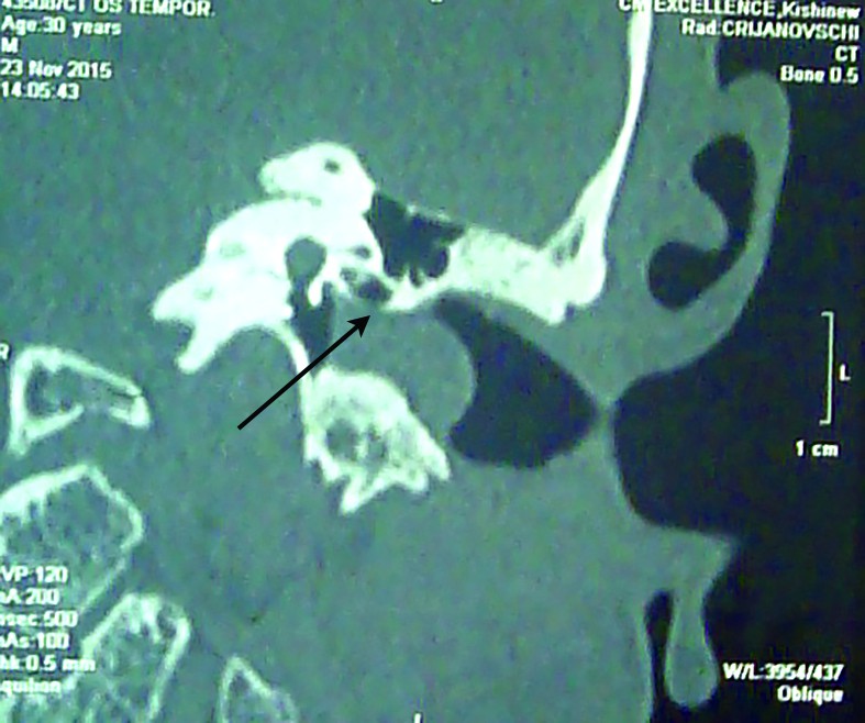 Figura 1. Polip auricular de ureche stângă, cu inserție osiculară