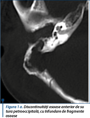 Figura 1 a. Discontinuități osoase anterior de sutura petrooccipitală, cu înfundare de fragmente osoase