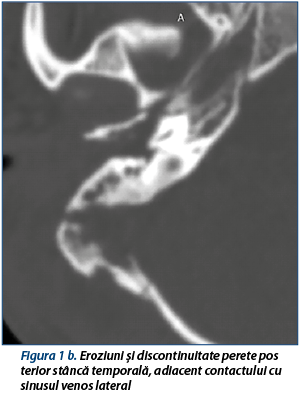 Figura 1 b. Eroziuni și discontinuitate perete posterior stâncă temporală, adiacent contactului cu sinusul venos lateral