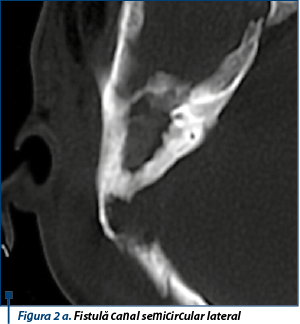 Figura 2 a. Fistulă canal semicircular lateral