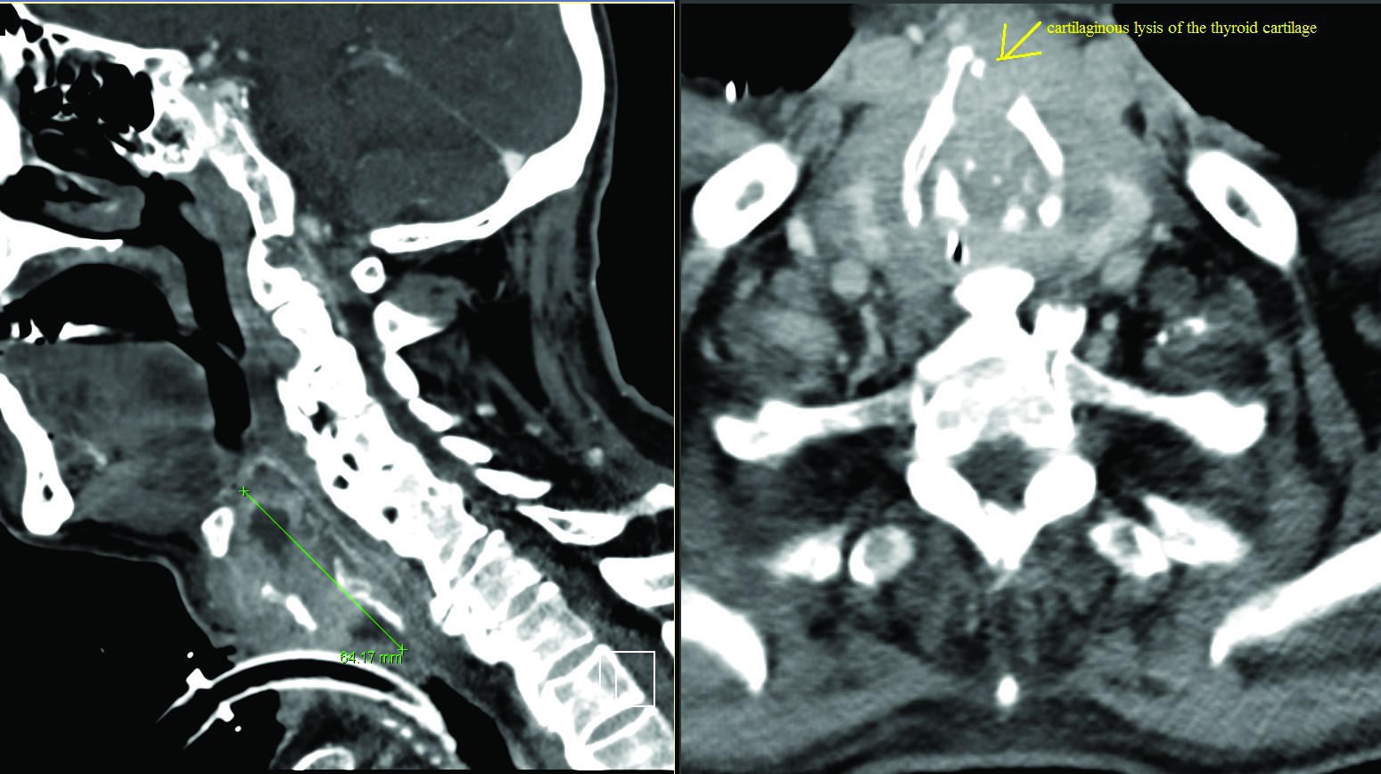 Figure 1. Locally advanced laryngeal tumor invading thyroid cartilage and bilateral piriform sinuses 