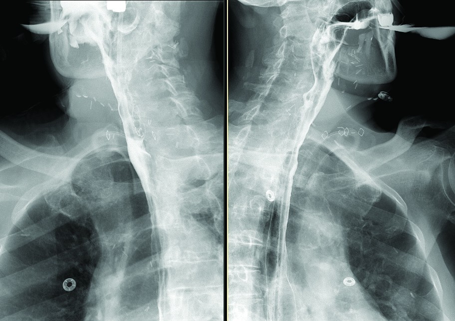 Figure 3. Post laryngectomy radiographic swallowing study
