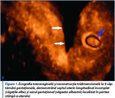 Figura 1. Ecografie transvaginală și reconstrucție tridimensională la 9 săp­tă­­mâni gestaționale, demonstrând septul uterin longitudinal incomplet (să­ge­țile albe) și sacul gestațional (săgeata albastră) localizat în partea stân­gă a uterului