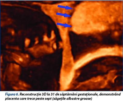 Figura 6. Reconstrucție 3D la 31 de săptămâni gestaționale, demonstrând placenta care trece peste sept (săgețile albastre groase)