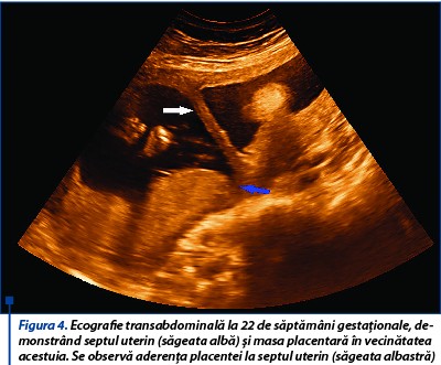 Figura 4. Ecografie transabdominală la 22 de săptămâni gestaționale, demonstrând septul uterin (săgeata albă) și masa placentară în vecinătatea acestuia. Se observă aderența placentei la septul uterin (săgeata albastră)