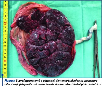Figura 8. Suprafaţa maternă a placentei, demonstrând infarcte placentare albe şi roşii şi depozite calcare induse de sindromul antifosfolipidic obstetrical