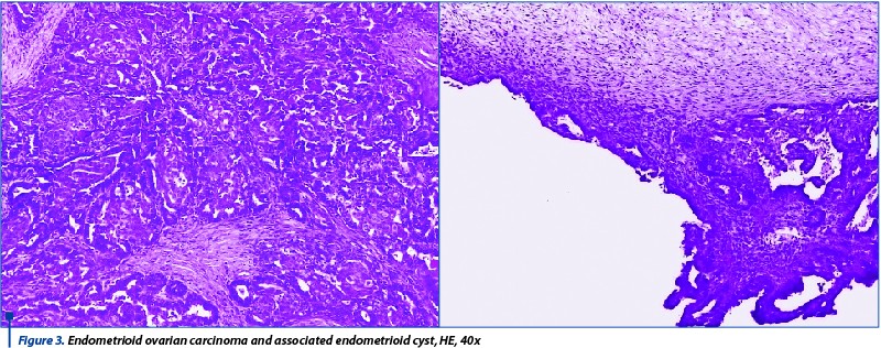 Figure 3. Endometrioid ovarian carcinoma and associated endometrioid cyst, HE, 40x