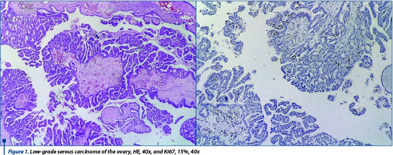 Figure 1. Low-grade serous carcinoma of the ovary, HE, 40x, and Ki67, 15%, 40x