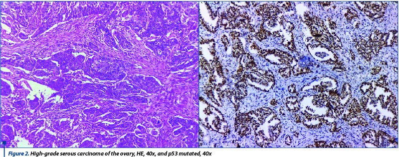 Figure 2. High-grade serous carcinoma of the ovary, HE, 40x, and p53 mutated, 40x