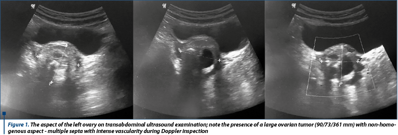 Figure 1. The aspect of the left ovary on transabdominal ultrasound examination; note the presence of a large ovarian tumor (90/73/361 mm) with non-homogenous aspect - multiple septa with intense vascularity during Doppler inspection