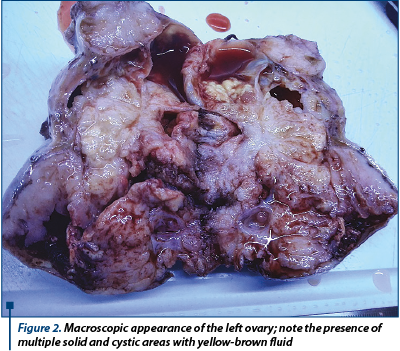 Figure 2. Macroscopic appearance of the left ovary; note the presence of multiple solid and cystic areas with yellow-brown fluid