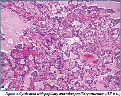 Figure 4. Cystic area with papillary and micropapillary structures (H.E. x 10)