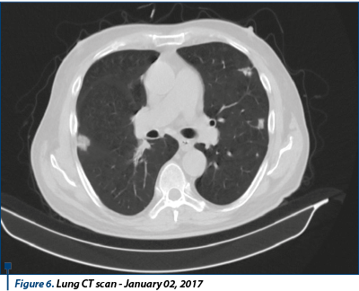 Figure 6. Lung CT scan - January 02, 2017