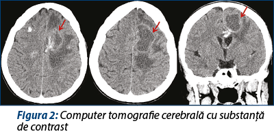 Figura 2. Computer tomografie cerebrală cu substanță de contrast 