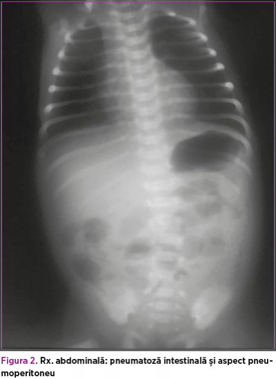 Figura 2. Rx. abdominală: pneumatoză intestinală şi aspect pneumoperitoneu
