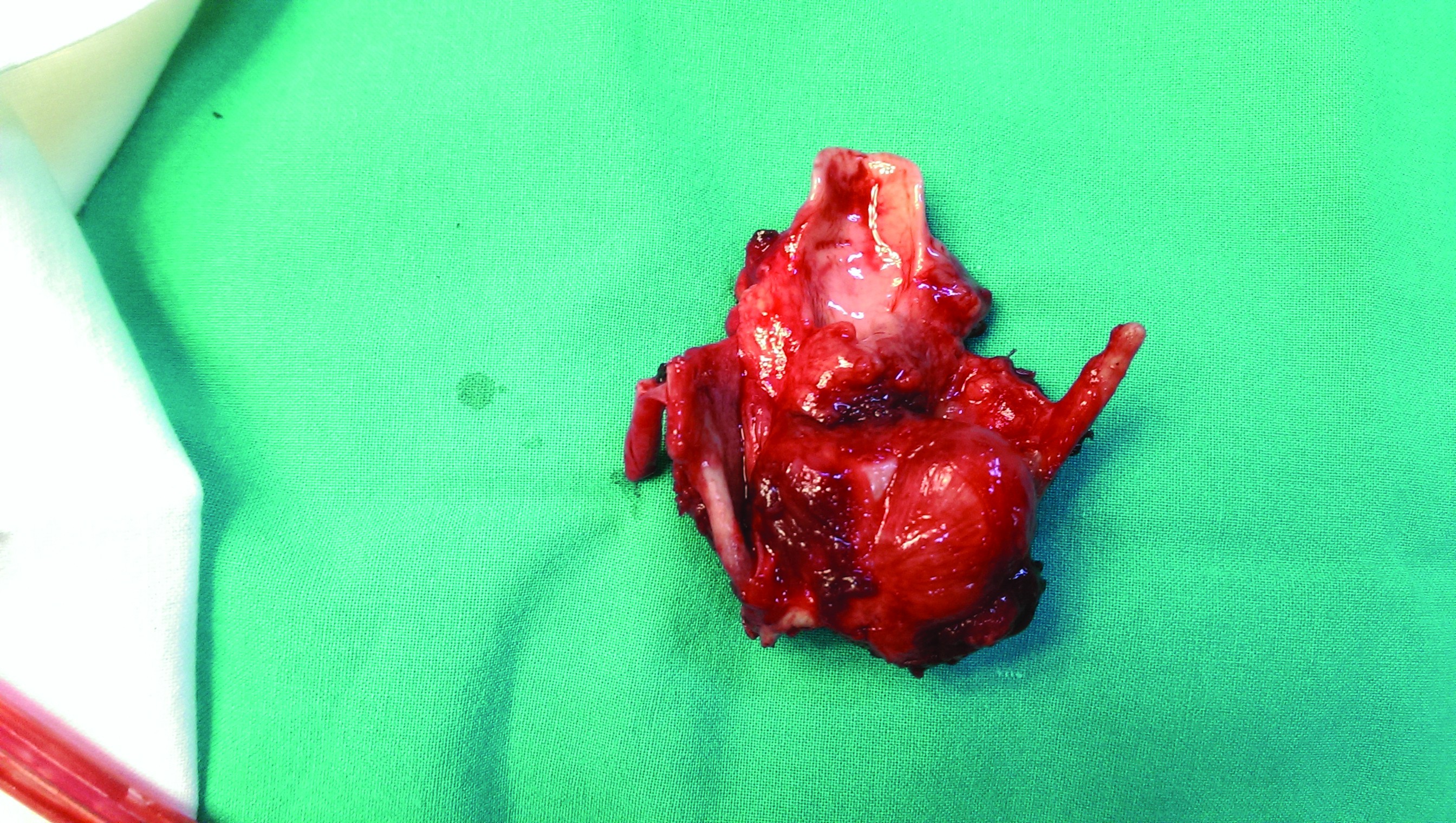 Figura 8. Aspect intraoperator după tirotomia mediană. Se observă hemilaringele drept, ocupat de formațiunea tumorală, mucoasa endolaringiană fiind de aspect normal