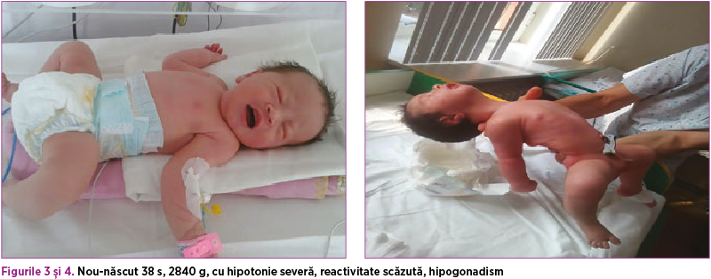 Figurile 3 şi 4. Nou-născut 38 s, 2840 g, cu hipotonie severă, reactivitate scăzută, hipogonadism