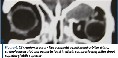 Figura 6. CT cranio-cerebral - liza completă a plafonului orbitar stâng,  cu deplasarea globului ocular în jos şi în afară; compresia muşchilor drept superior şi oblic superior
