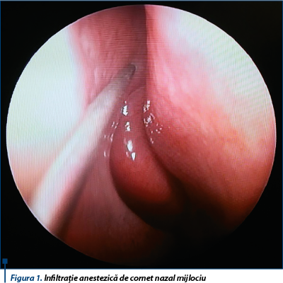 Figura 1. Infiltraţie anestezică de cornet nazal mijlociu 