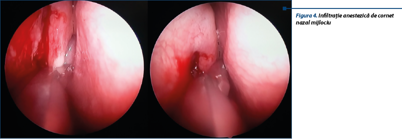 Figura 4. Infiltraţie anestezică de cornet nazal mijlociu 