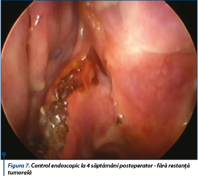 Figura 7. Control endoscopic la 4 săptămâni postoperator - fără restanță tumorală