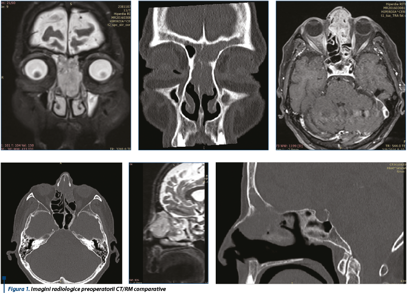 Figura 1. Imagini radiologice preoperatorii CT/RM comparative
