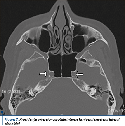 Figura 7. Procidența arterelor carotide interne la nivelul peretelui lateral sfenoidal