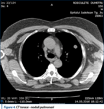 Figura 4. CT torace - noduli pulmonari
