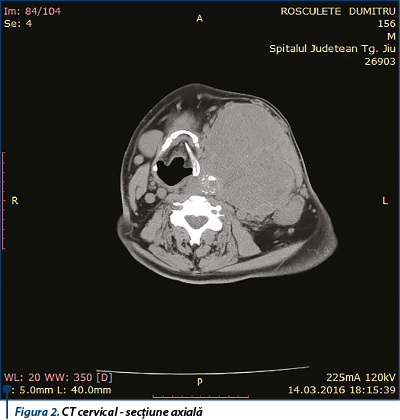 Figura 2. CT cervical - secțiune axială
