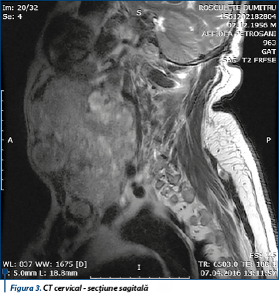 Figura 3. CT cervical - secțiune sagitală