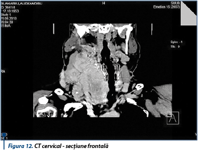 Figura 12. CT cervical - secțiune frontală